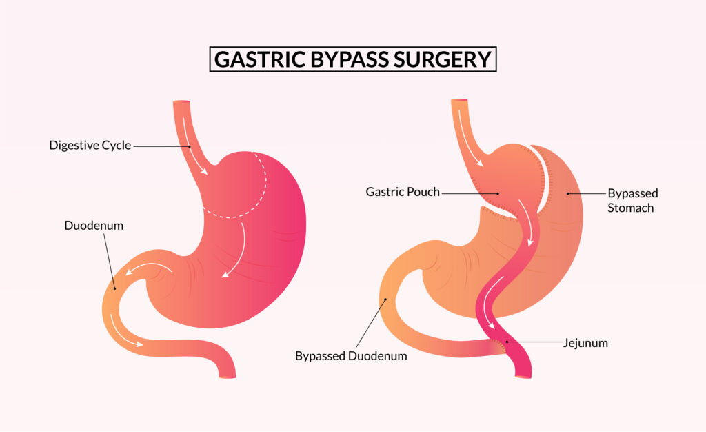 cirurgia bypass, o médico retira uma parte do estômago e liga a parte que sobrou diretamente ao intestino.