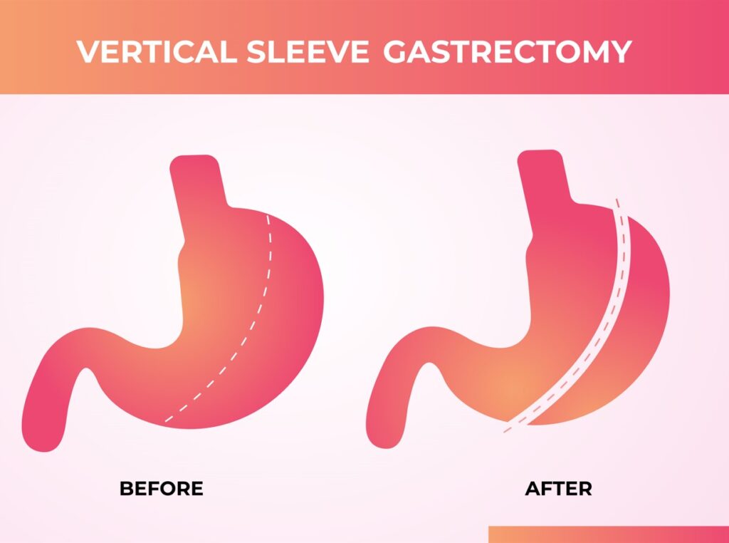 cirurgia sleeve vertical,  o médico também retira parte do estômago, em torno de 80%,  porém, mantém a ligação natural do estômago ao intestino. 